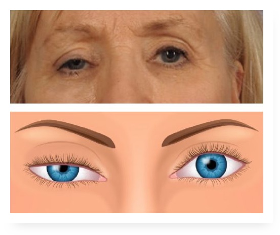 ptosis-drooping-eyelids-in-adults-1024-x-473