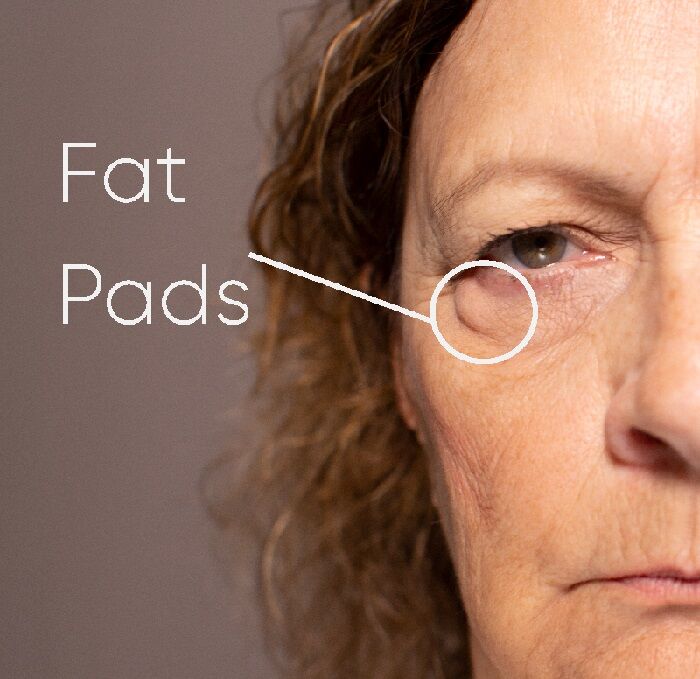 Zephyrhills Fat Pad Removal Florida Face And Body