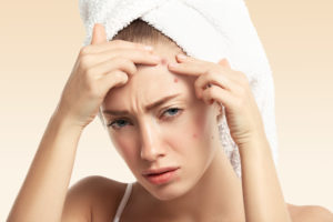 Treating Acne