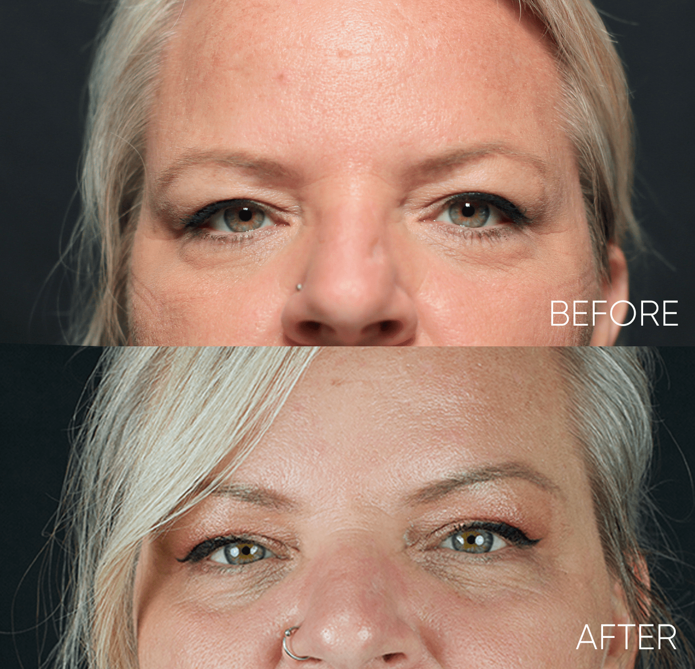 Alesia Brow lift BOTOX (1)-min